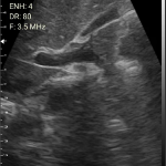 wireless usg Common bile duct