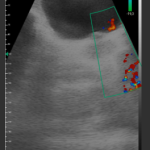 Wireless USG Full-bladder