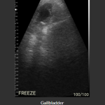 Wireless usg Gallbladder