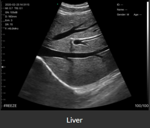 wireless usg Liver