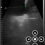 wireless usg Pleural effusion