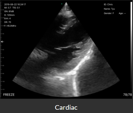 handheld wireless usg cardiac