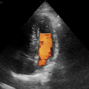 Wireless USG Cardiac sonowave